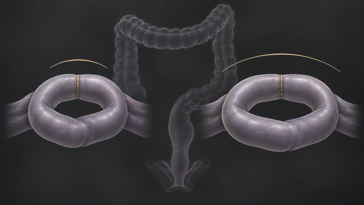 Original medical illustration for: Closing a Protective Ileostomy Early or Late After Rectal Cancer Surgery: What a New Review of Nine Trials Found